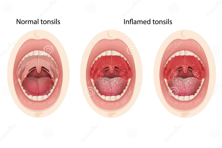 Normal And Inflamed Tonsils Illustration Of A Throat Bacterial And Viral Infection Stock Vector Illustration Of Tonsillitis Bacterial 247763180