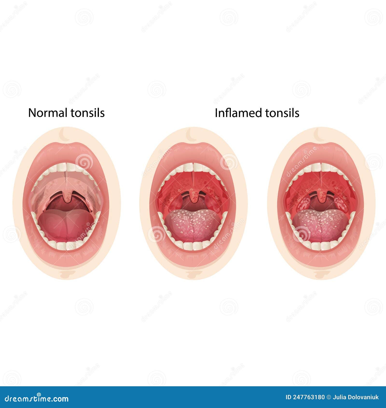 Normal And Inflamed Tonsils Illustration Of A Throat Bacterial And Viral Infection Stock Vector Illustration Of Tonsillitis Bacterial 247763180