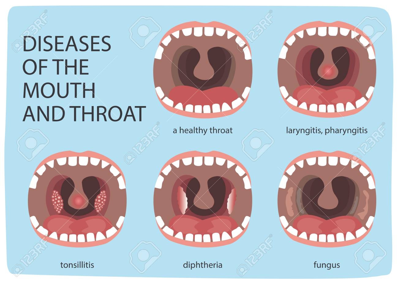 Poster Infographics Illustration Of A Healthy Throat Difference From Tonsillitis Stock Photo Picture And Royalty Free Image Image 100380819 